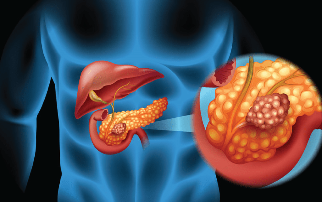 IIT Madras to develop biomarkers for early detection of pancreatic cancer